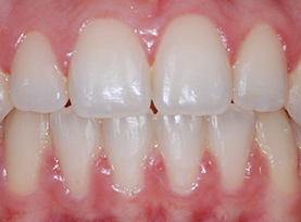After Treatment